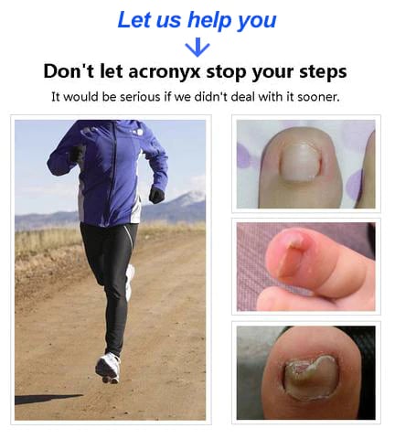 Cumuul Nagelknipser