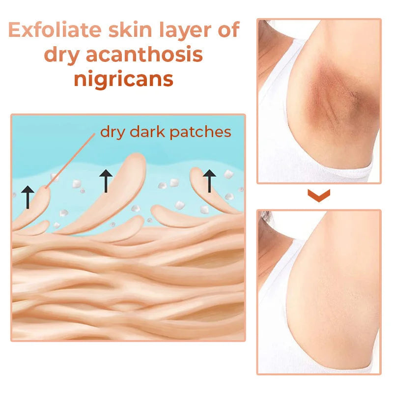 Huile Thérapeutique GFOUK™ Acanthosis Nigricans