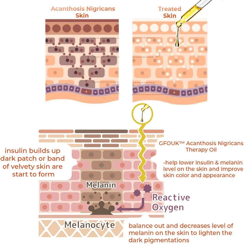 Huile Thérapeutique GFOUK™ Acanthosis Nigricans