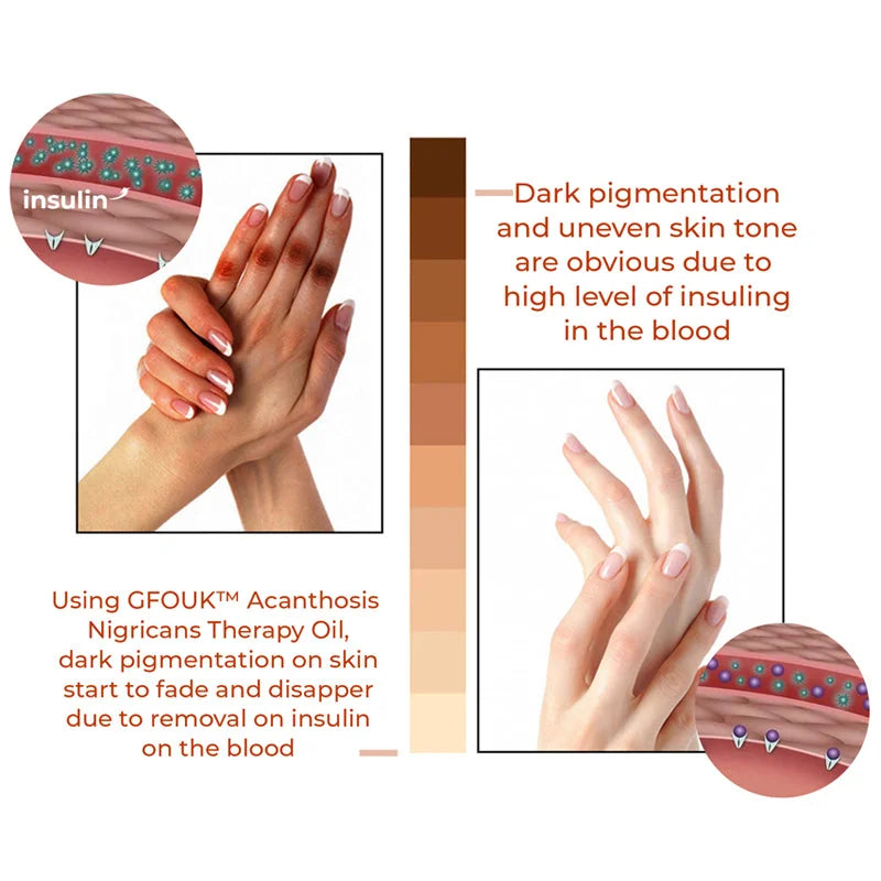 Huile Thérapeutique GFOUK™ Acanthosis Nigricans